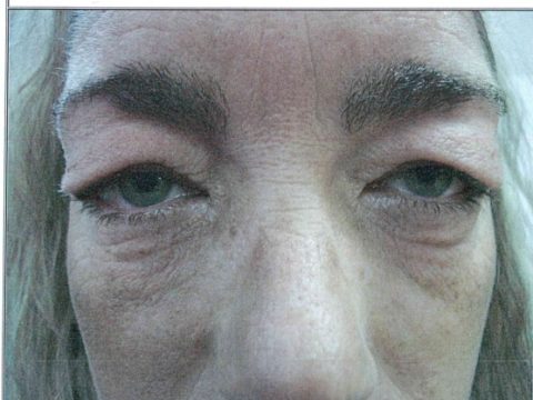 Eyelid Surgery in Michigan